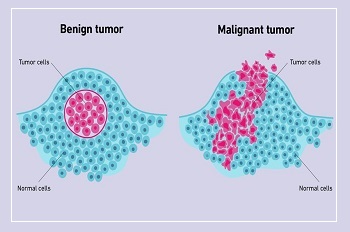 Are All Tumors Cancerous?
