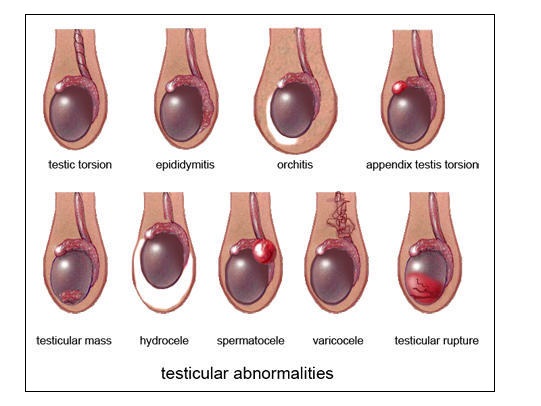 Testicular Cancer Outcome If Diagnosed Early