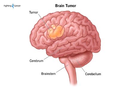 Is brain tumor life threatening?