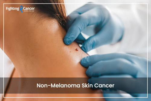Non-Melanoma Skin Cancer