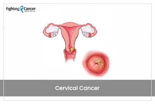 Cervical Cancer