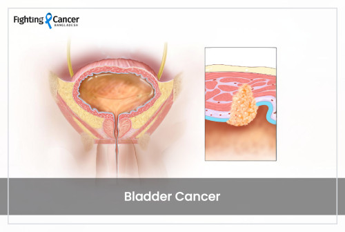 Bladder Cancer