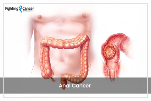 Anal Cancer
