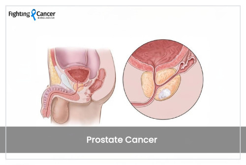 Prostate Cancer