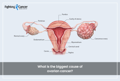 What is the biggest cause of ovarian cancer?