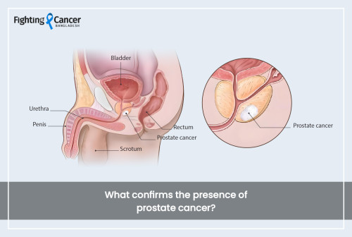 What confirms the presence of prostate cancer?