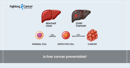 Is liver cancer preventable?