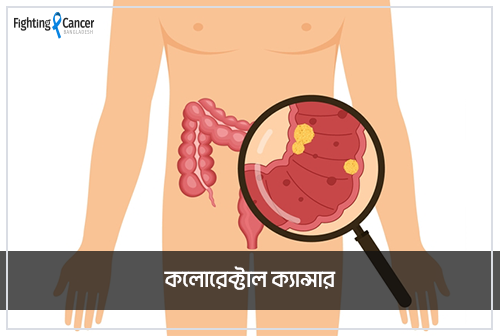 কলোরেক্টাল ক্যান্সার