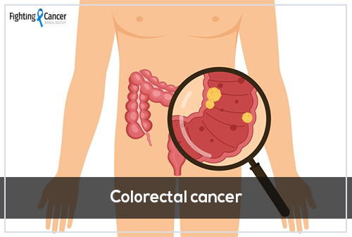 Colorectal Cancer